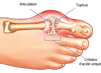 Goutte: les excès alimentaires aggravent la maladie