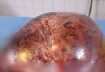 CMA de Boromo: l’équipe a réussi à extraire un kyste de 8,9 kg