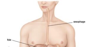 La maladie de Crohn : les complications nécessitent une prise en charge médicale urgente