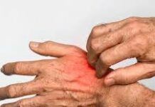 La gale, une maladie très contagieuse