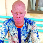 Personnes atteintes d’albinisme: le combat vital contre le cancer de la peau