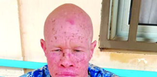 Personnes atteintes d’albinisme: le combat vital contre le cancer de la peau