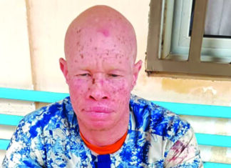 Personnes atteintes d’albinisme: le combat vital contre le cancer de la peau