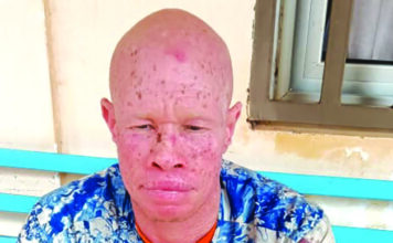 Personnes atteintes d’albinisme: le combat vital contre le cancer de la peau