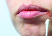 La perlèche: une maladie bénigne mais qui peut provoquer de l’inconfort