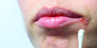 La perlèche: une maladie bénigne mais qui peut provoquer de l’inconfort