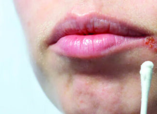 La perlèche: une maladie bénigne mais qui peut provoquer de l’inconfort