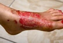 La prise en charge médicale des brûlures diffère selon leurs origines