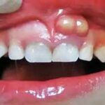 L’abcès dentaire : non traité à temps, il peut provoquer d’autres infections