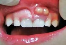 L’abcès dentaire : non traité à temps, il peut provoquer d’autres infections