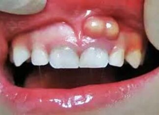 L’abcès dentaire : non traité à temps, il peut provoquer d’autres infections