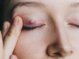 Le cancer des paupières : la majorité des cas sont peu agressifs