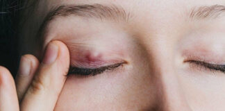 Le cancer des paupières : la majorité des cas sont peu agressifs