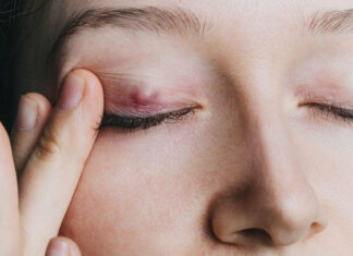 Le cancer des paupières : la majorité des cas sont peu agressifs