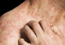 Carnet santé : Eruption cutanée, Les causes sont multiples