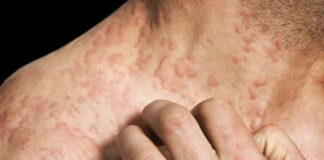 Carnet santé : Eruption cutanée, Les causes sont multiples