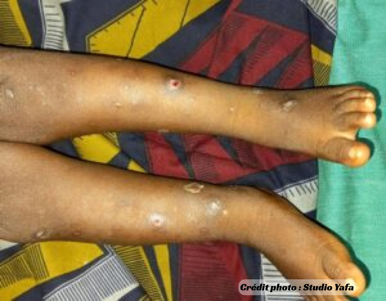 Les plaies de saison désignent une affection de la peau très fréquente chez les enfants au Burkina Faso.